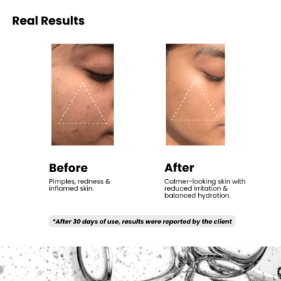 Before and after using aloe vera gel