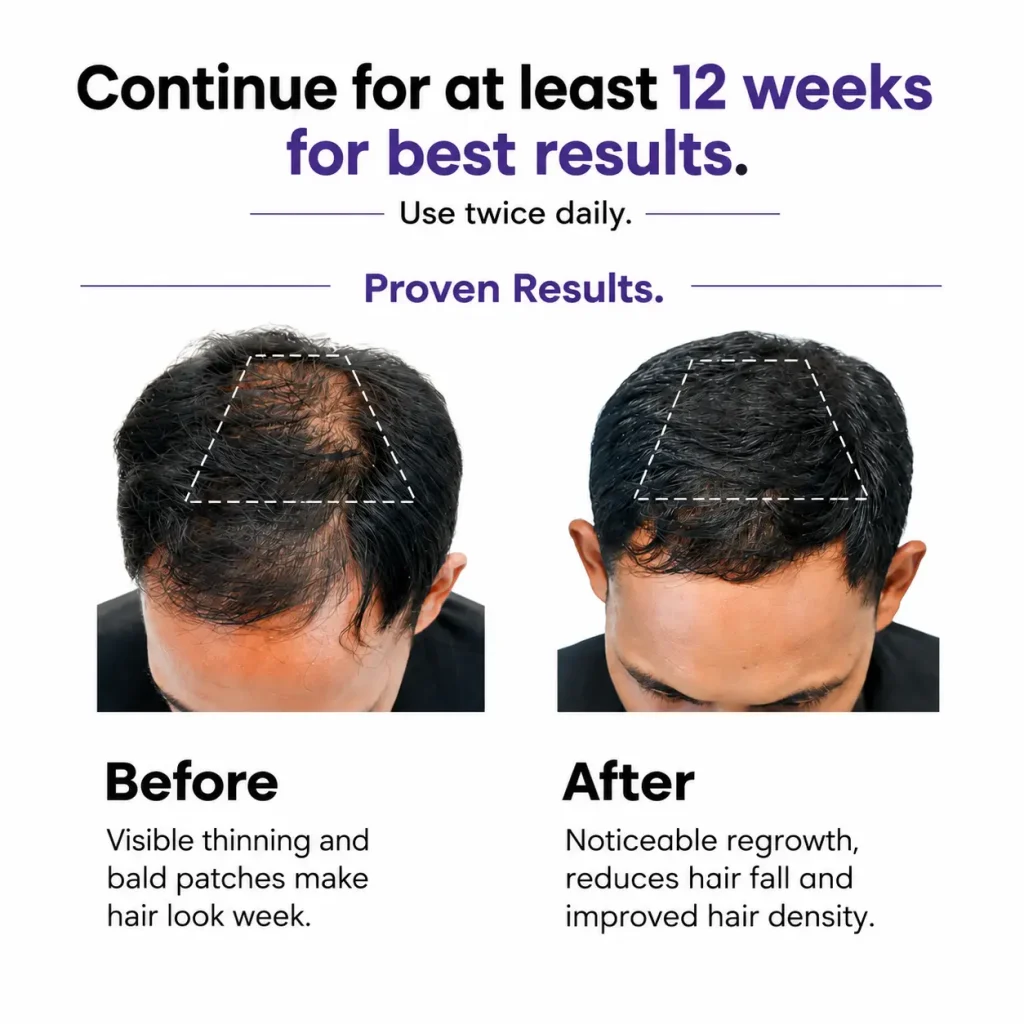 Before and After Result using hair serum for men